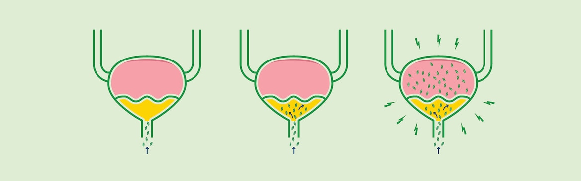 Ilustrace znázorňující, jak se bakterie při infekci močových cest dostávají do močového měchýře.