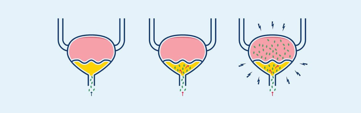 Illustration of how bacteria infect the bladder in a urinary tract infection