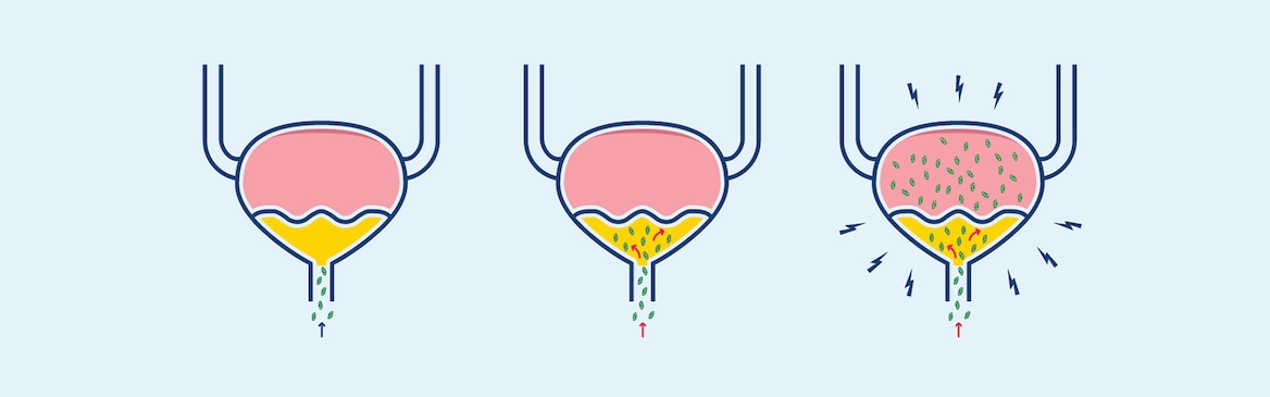 Ilustración de cómo las bacterias infectan la vejiga en una infección del tracto urinario