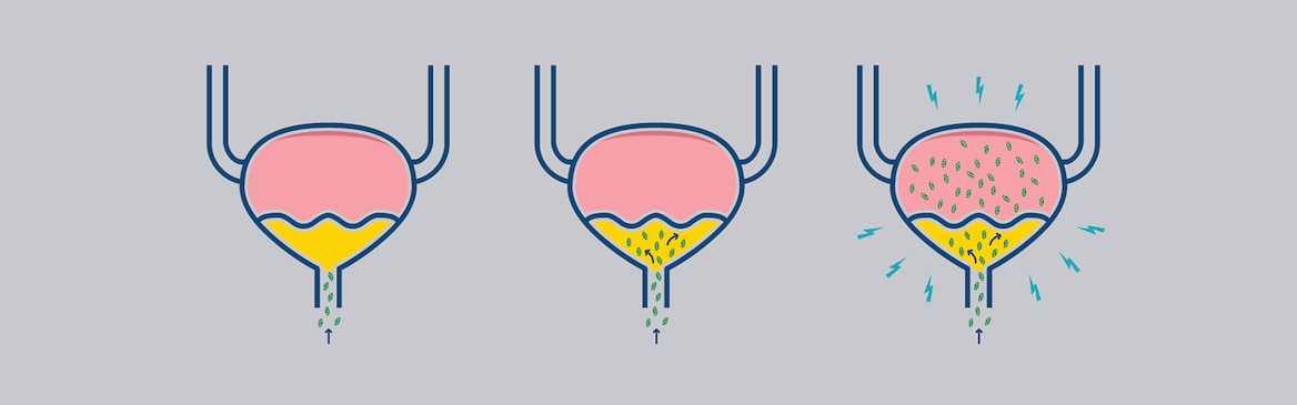 Ilustrācija, kurā redzams, kā baktērijas inficē urīnpūsli urīnceļu infekcijā
