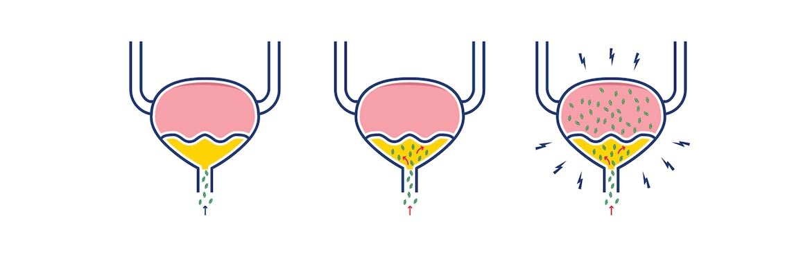 Ilustrácia spôsobu infekcie močového mechúra baktériami pri infekcii močových ciest.