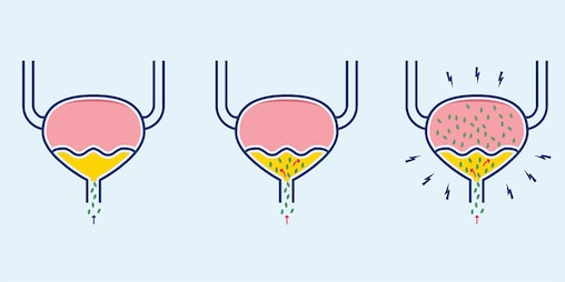 Illustration of how bacteria infect the bladder in a urinary tract infection