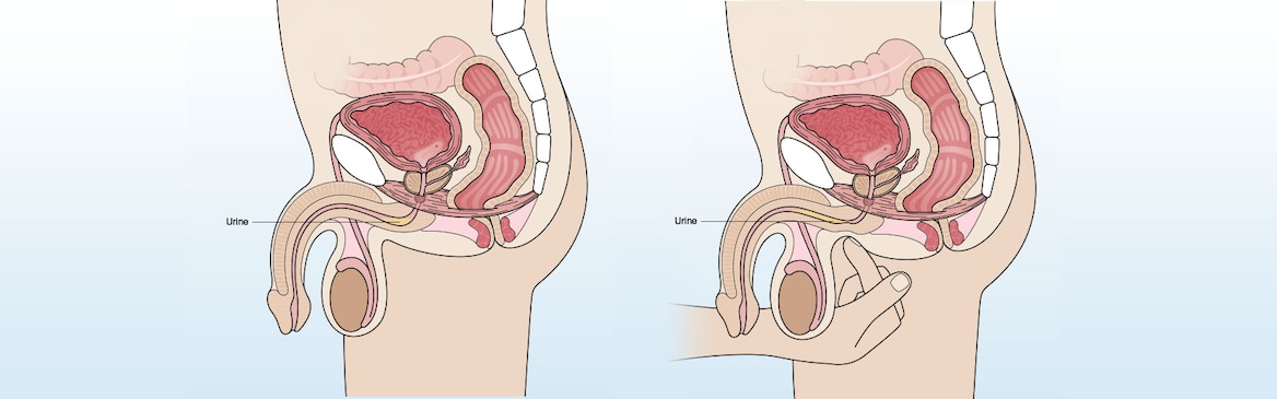 Anatomic illustration of a finger pressing on the urethra behind the scrotum, pushing trapped urine forward. 