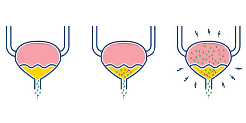 An illustration shows urinary tract infection