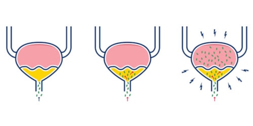 An illustration shows urinary tract infection